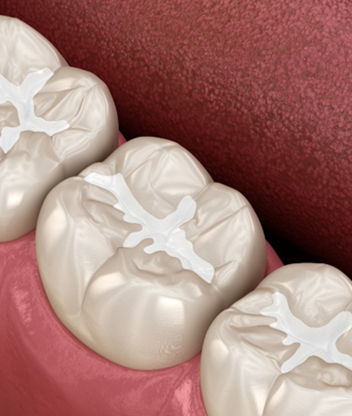 Three tooth-colored fillings 