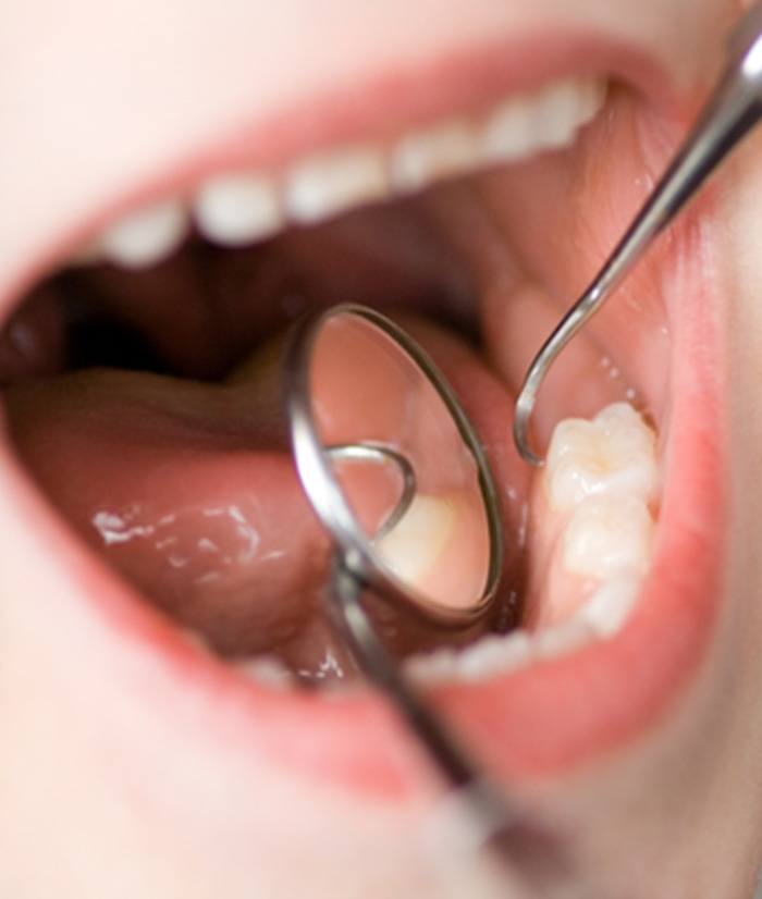 A child’s mouth after receiving a tooth-colored filli 