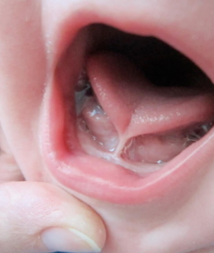 Closeup of smile with lip and tongue tie