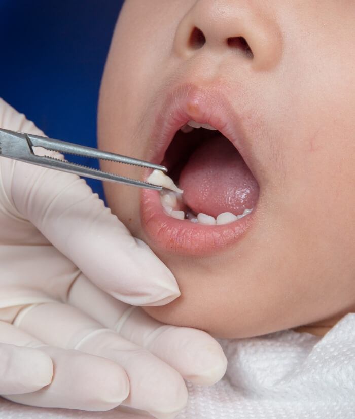 Pediatric dentist performing tooth extraction